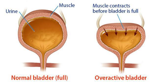 8 Natural Ways To Treat Overactive Bladder Without Medication Just 